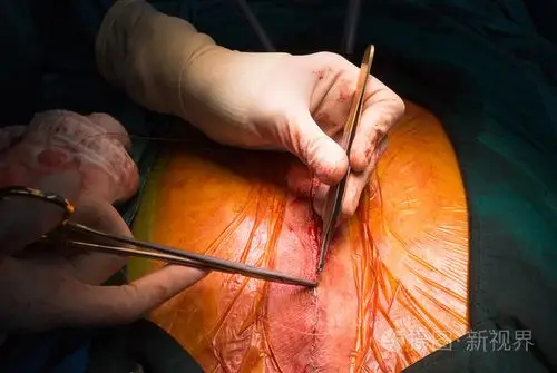 缝合关闭胸骨切口