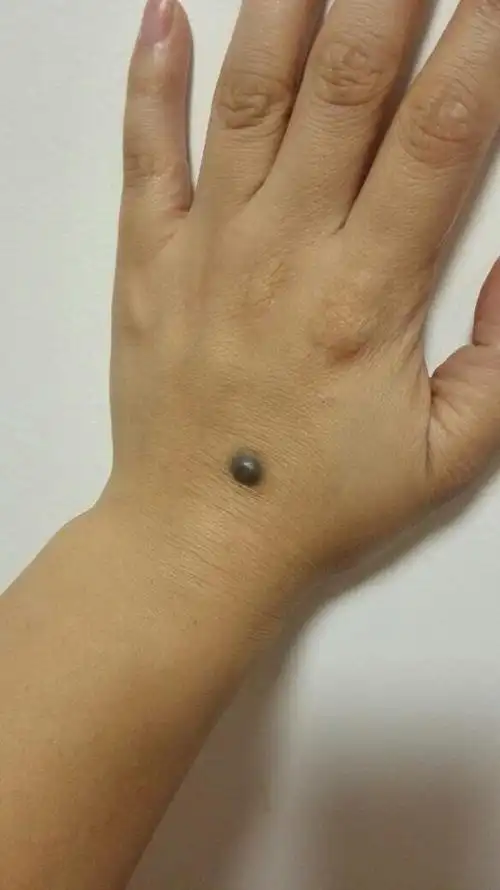 凸出皮肤的是痣么