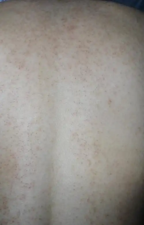 展开全部 背上长很多红点,有可能是湿疹,也有可能是毛囊