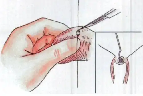 "阉割"和"结扎"的区别,老公该知道_上环