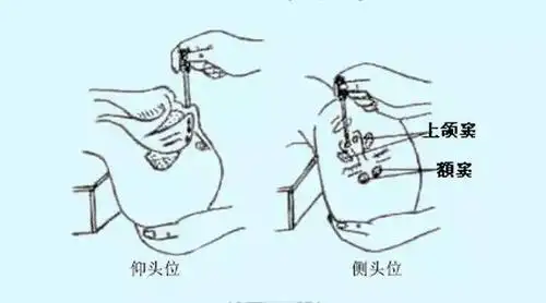 因此滴鼻时可头向后仰,适当吸气,方可使药液尽量达到较深部位,使用