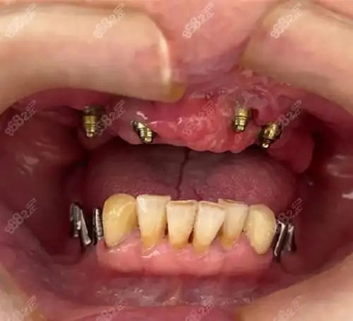半口种植牙图片