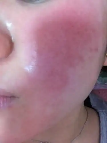 01,一旦面部发生皮肤过敏症状,不要用热水烫或蒸面等方法来解痒,可用