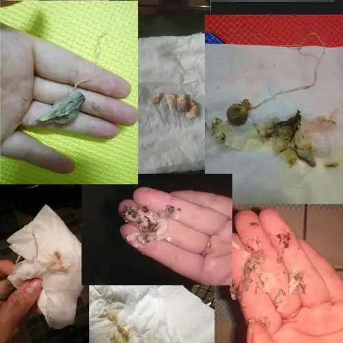 清宫丸正品【8颗 8支妇科凝胶】排毒丸妇科炎症用品私处护理8粒装