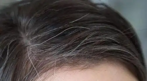 为什么人到了40岁,有的人白发多,有的人白发少?