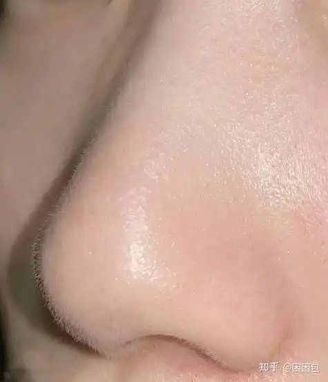 鼻子上黑头很严重毛孔粗大怎么办