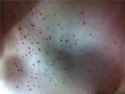 艾滋病疙瘩真实图片,高危后的疙瘩最可怕