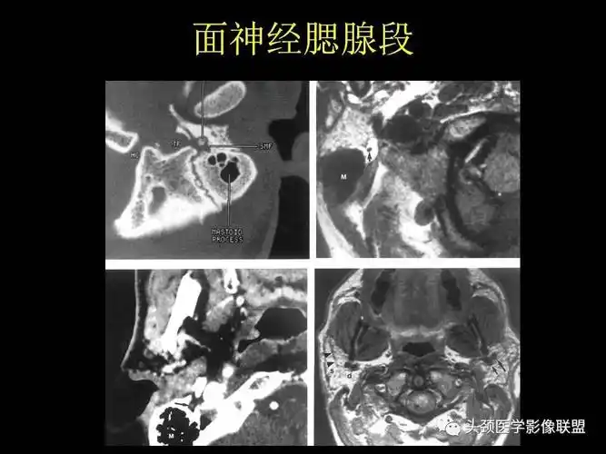 面神经的影像学诊断