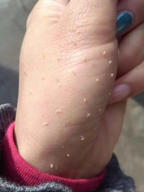 脸上挤出来的,这种叫黑头还是粉刺?