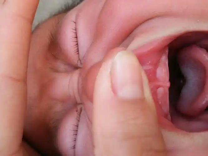 牙龈上鼓包是怎么回事