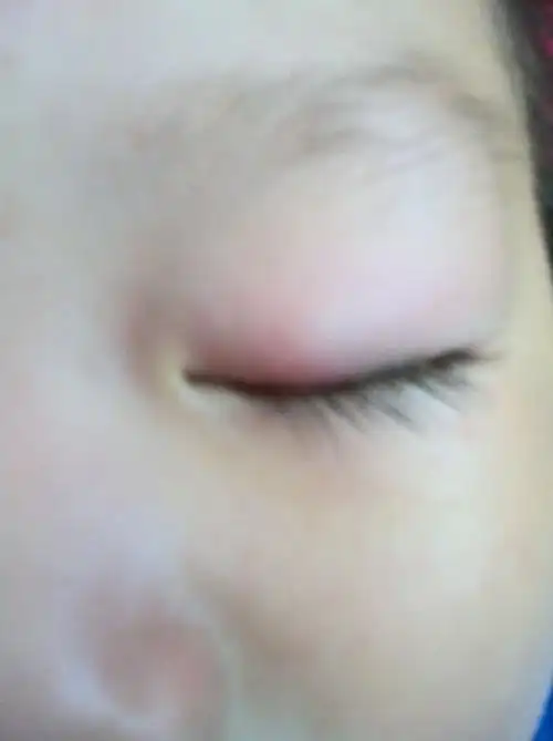 问:我家宝宝两岁眼皮里面长了个疙瘩,摸着有点硬,看着眼睛像肿的一样