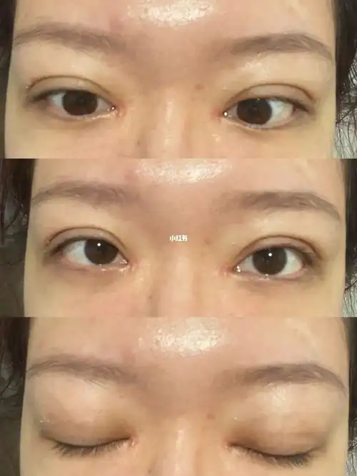 第17天 三点定位双眼皮