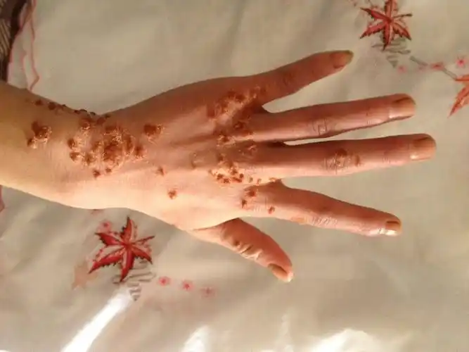 然后手部如图所示,出现很多这样的疣体,激光了又复发.不发痒,也