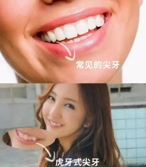 虎牙这个位置的牙其实叫做尖牙,不管有虎牙还是没虎牙,尖牙是人人都有