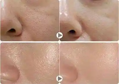 上海美莱治疗毛孔粗大对比案例图