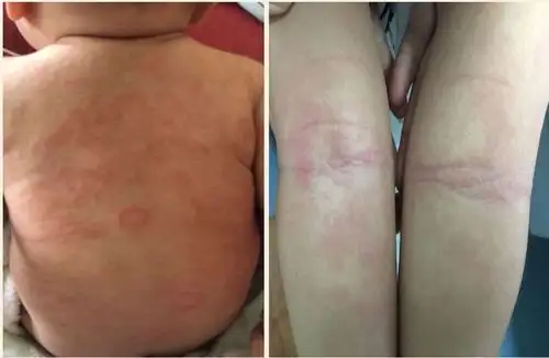 特应性皮炎的皮肤表现