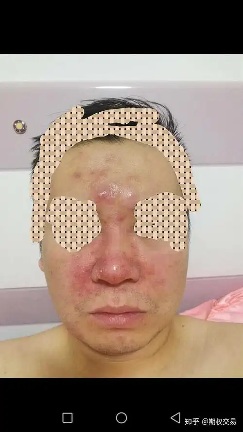 被确诊为玫瑰痤疮 , 被玫瑰毁容了,现在服用美满消炎药 ,外用微诺娜