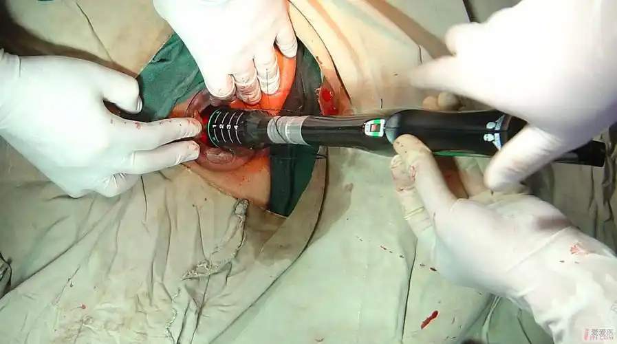 强生吻合器照片