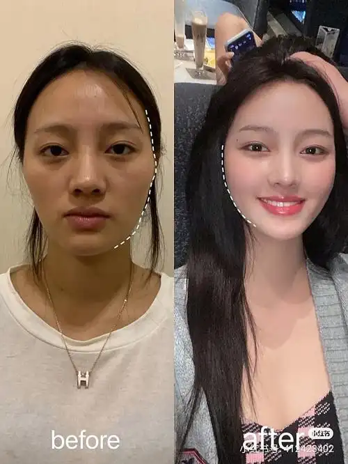 自体脂肪填充面部之后呀,看看对比效果太明显了哦我脸_圈子-新氧美容