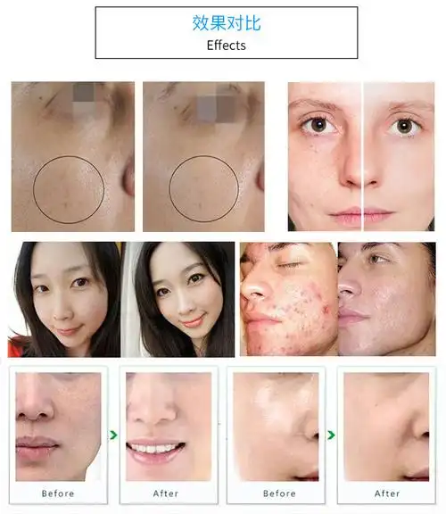 多功能高氧护理仪好皮肤氧出来