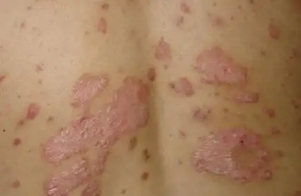 艾滋病一开始的皮肤图女性