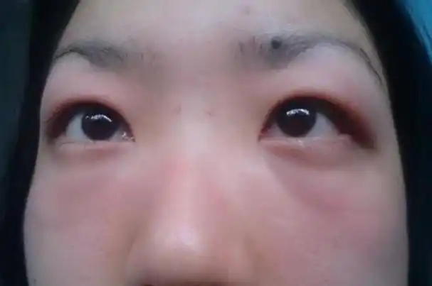 早上起床后,若身体出现4个表现,可能是暗示病症,早知早预防眼睛浮肿