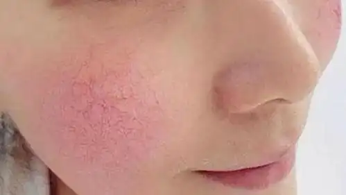 谁说红血丝就没救了敏感红血丝应该这样解决