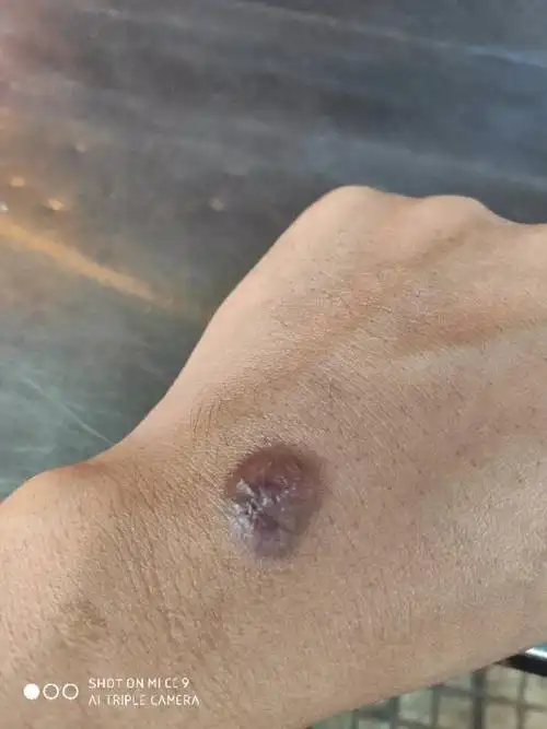 烟烫伤,好了以后伤口发黑怎么处理?