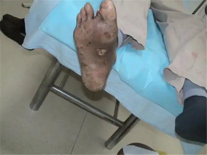 2级糖尿病足图片