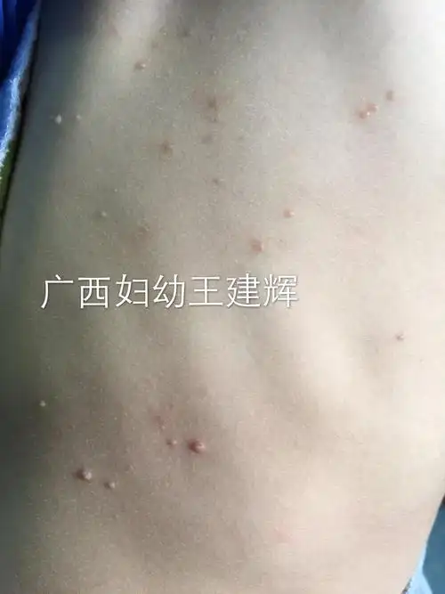 常见皮肤病彩色图片 - 好大夫在线