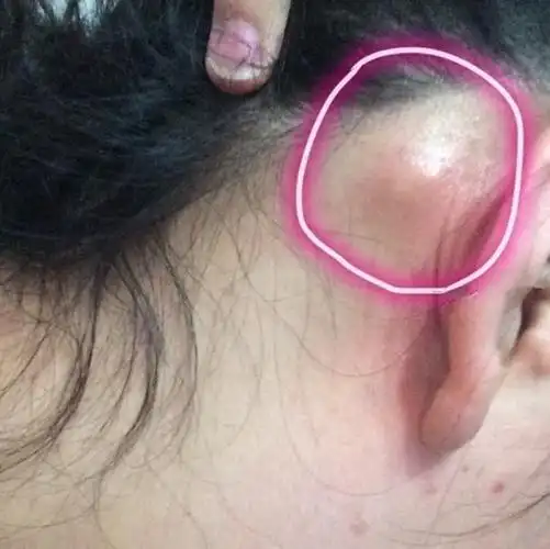 淋巴癌中度患者耳部女孩字图片