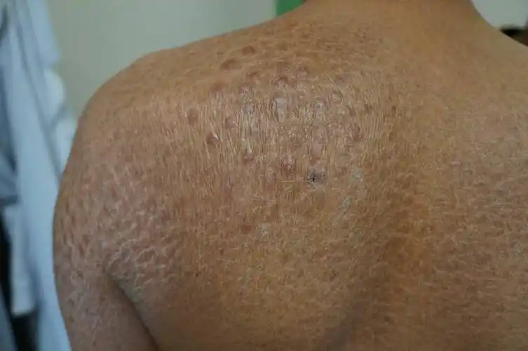 成年鱼鳞病要警惕恶性肿瘤_银屑病_疾病介绍_介绍 - 好大夫在线