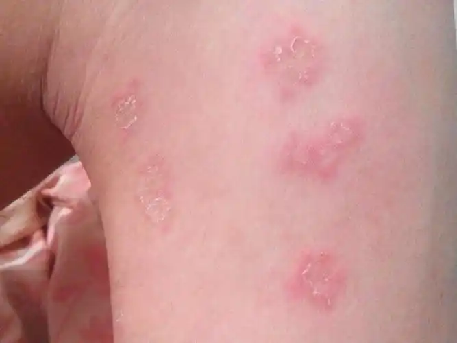 大腿上起了许多红色像癣一样的东西,很痒,一抓就像掉皮似的,这是怎么