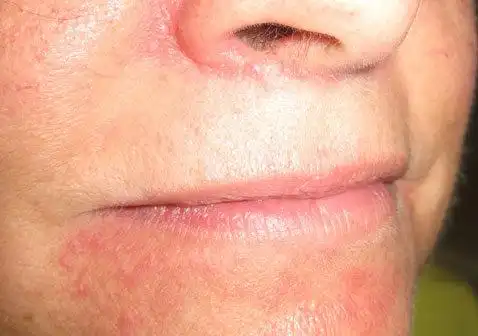 脸部牛皮肤癣图片:初期症状和治疗药膏-中华银屑病网