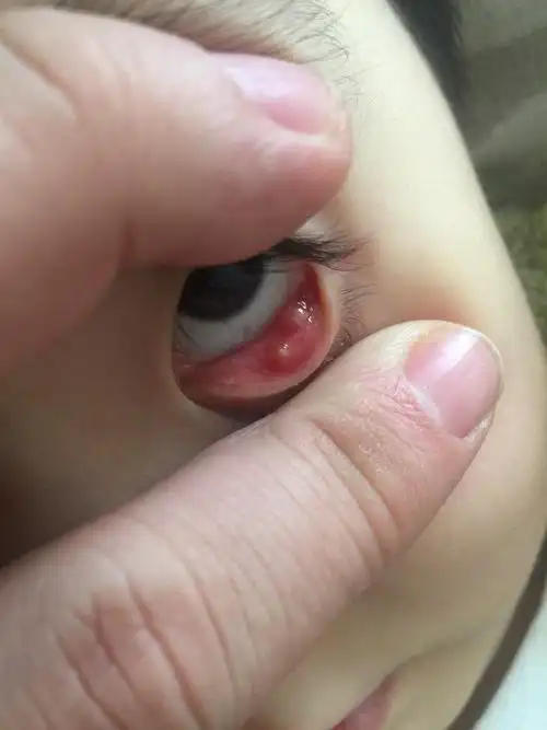 病情描述:霰粒肿咨询咨询问题