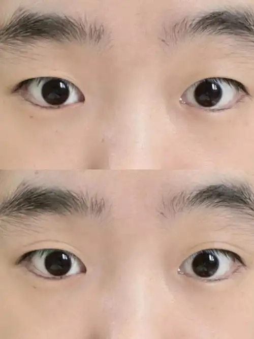 单眼皮变双眼皮什么魔法