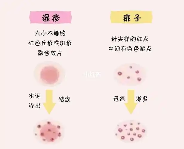 宝宝湿疹痱子如何区分71