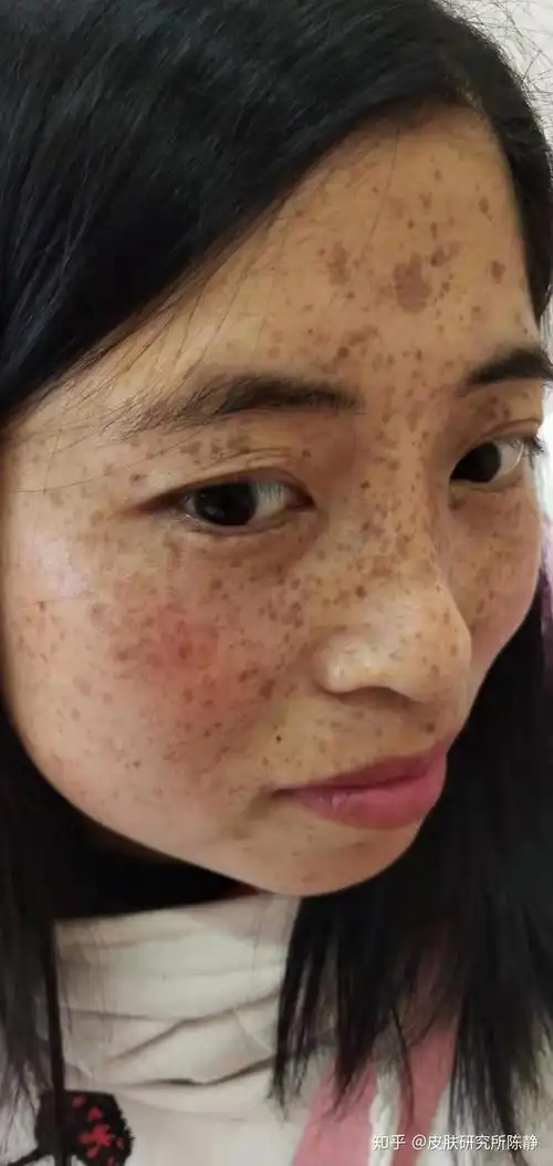 你面部色斑知多少