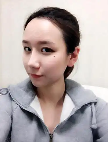 面部脂肪填充希克丽整形外科医院