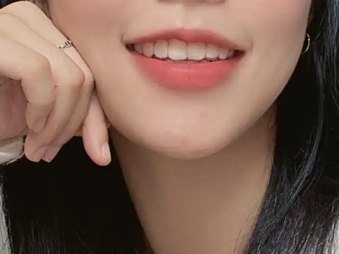 诉求经常有朋友问我拍照笑不露齿因为牙齿有外凸不整齐呀导致拍照不敢