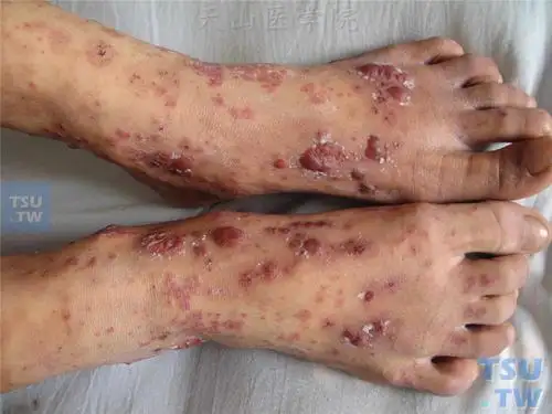 【图】变应性皮肤血管炎的症状表现 - 皮肤病诊断图谱 - 天山医学院