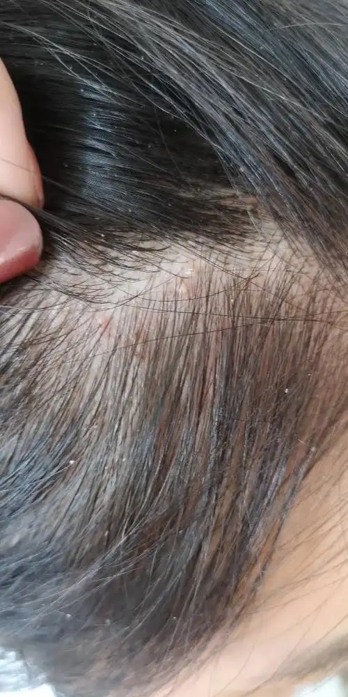 这个是怎么回事,有头皮屑,很痒