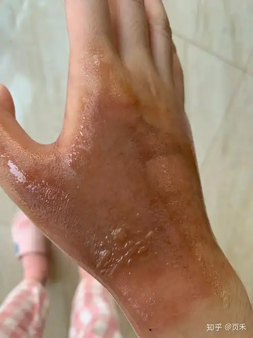 手被开水烫伤恢复记录多图慎入