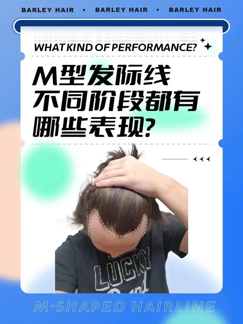 脱发阶段自查!m型发际线3个阶段特征总结.