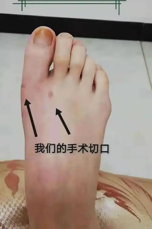 告别"拇外翻",让您"足"够完美_手术