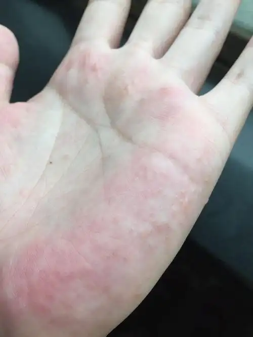 如图,一到夏天就有,平时手汗很多,擦了达克宁不见效,就是手指顶部和