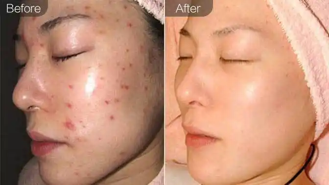 果酸&杏仁酸焕肤前后对比效果图