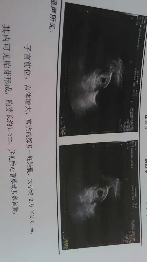 接健康胎心胎芽喽