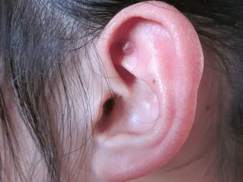 耳朵上长了一个包,希望有朋友能告诉我这是什么!个人很担心.怕有问题.
