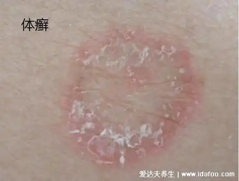 7, 体癣图片初期症状